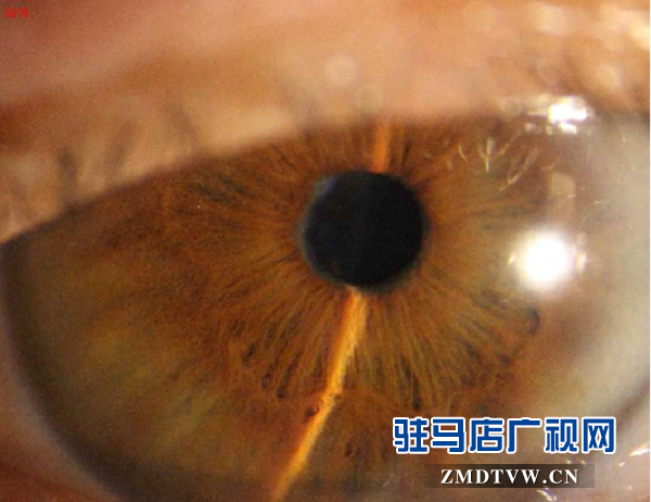 脫貧后，患眼疾20多年重見光明